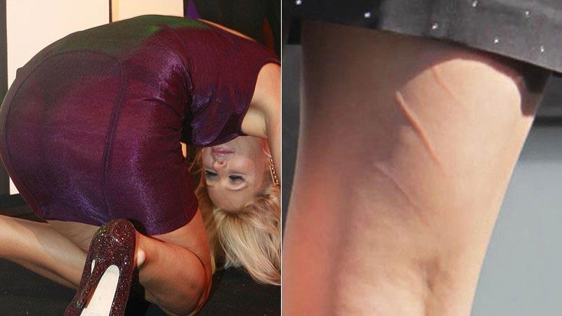 Paris Hilton tillber ölen – och Katy Perry har mystiska sår på benen.