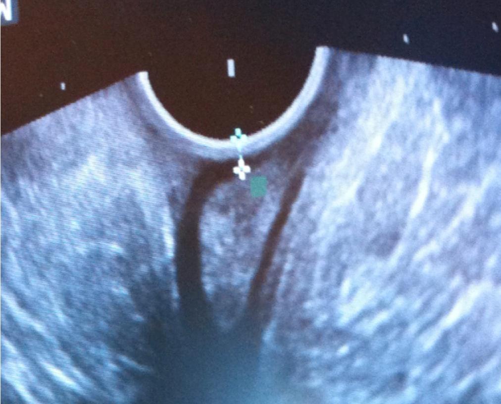 En svår bristing på slutmuskeln i ändtarmen efter en förlossning ser ut så här med tredimensionellt analt ultraljud.