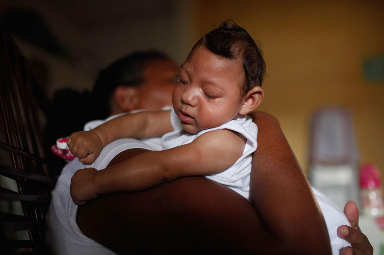 Ett barn med som fötts med fosterskador som misstänks ha orsakats av zikaviruset.
