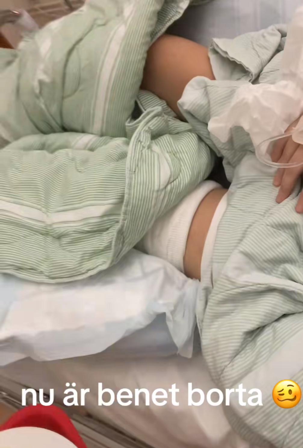 Dagen efter operationen i november 2023, då vaknade Isabel med sitt högra ben amputerat.