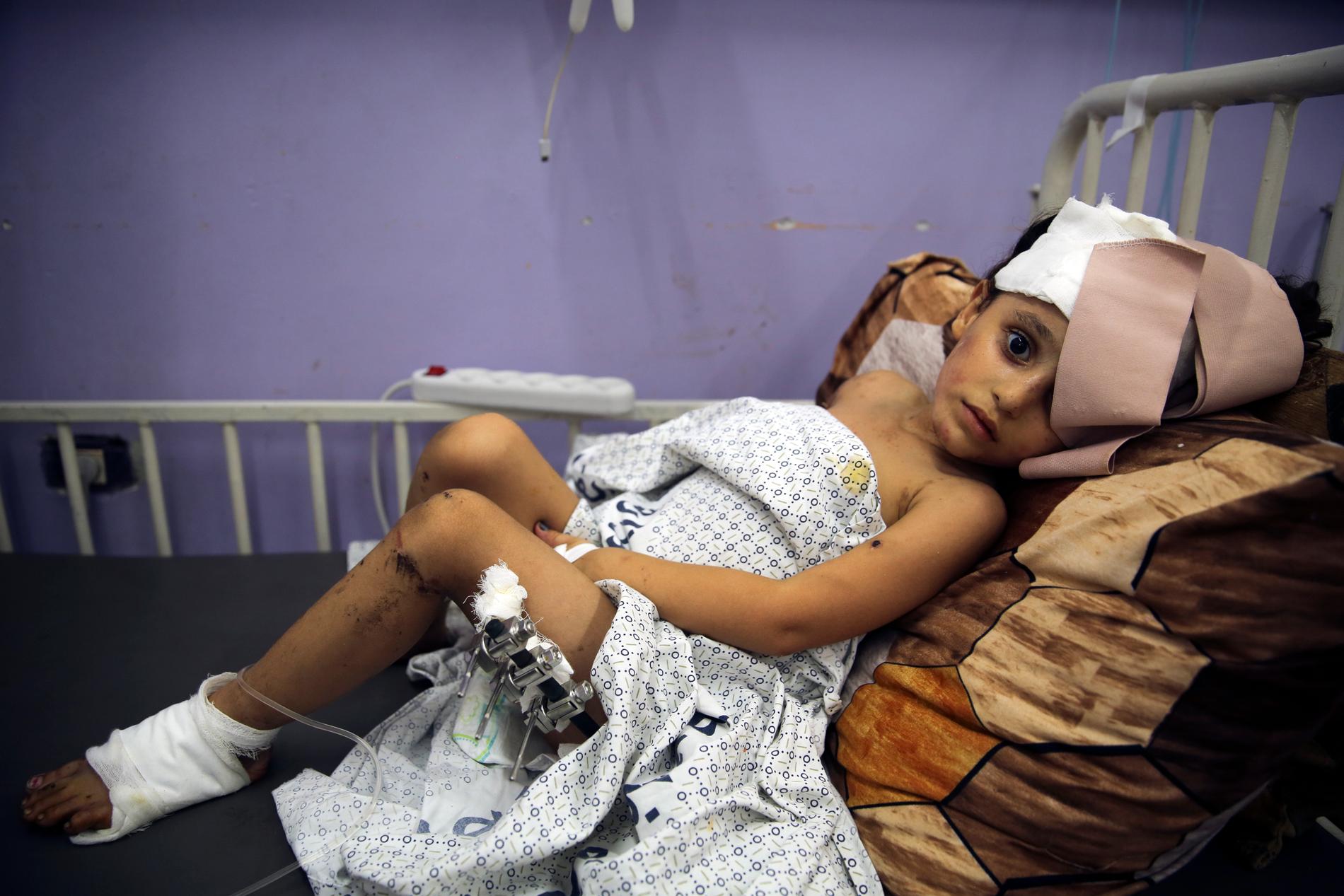Kenzi al Madhoun, 4, ligger skadad på Al-Aqsa-sjukhuset vid Gazaremsan, efter Israels bombningar, den 1 november, 2023.