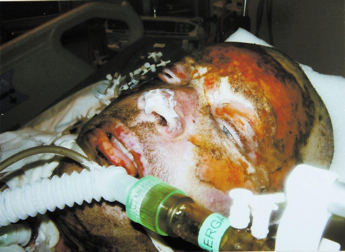 Pebben på sjukhuset med sitt svårt brända ansikte.