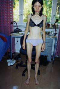 ”BILDERNA ÄCKLAR MIG” Sofie Hermansson vägde 25 kilo när hon fick hjärtstillestånd och var nära att dö. ”Jag var fångad av anorexidjävulen”, säger hon. ”Jag blir äcklad när jag ser bilder på mig själv när jag var sjuk. Jag tycker det är fruktansvärt att se bilderna i dag. Det känns som en annan person”, säger Sofie.Foto: Privat