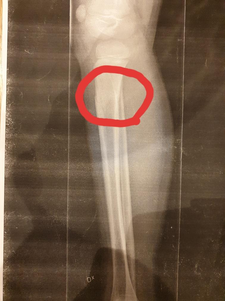 Alvins fraktur på röntgen visar att benet gick helt av.