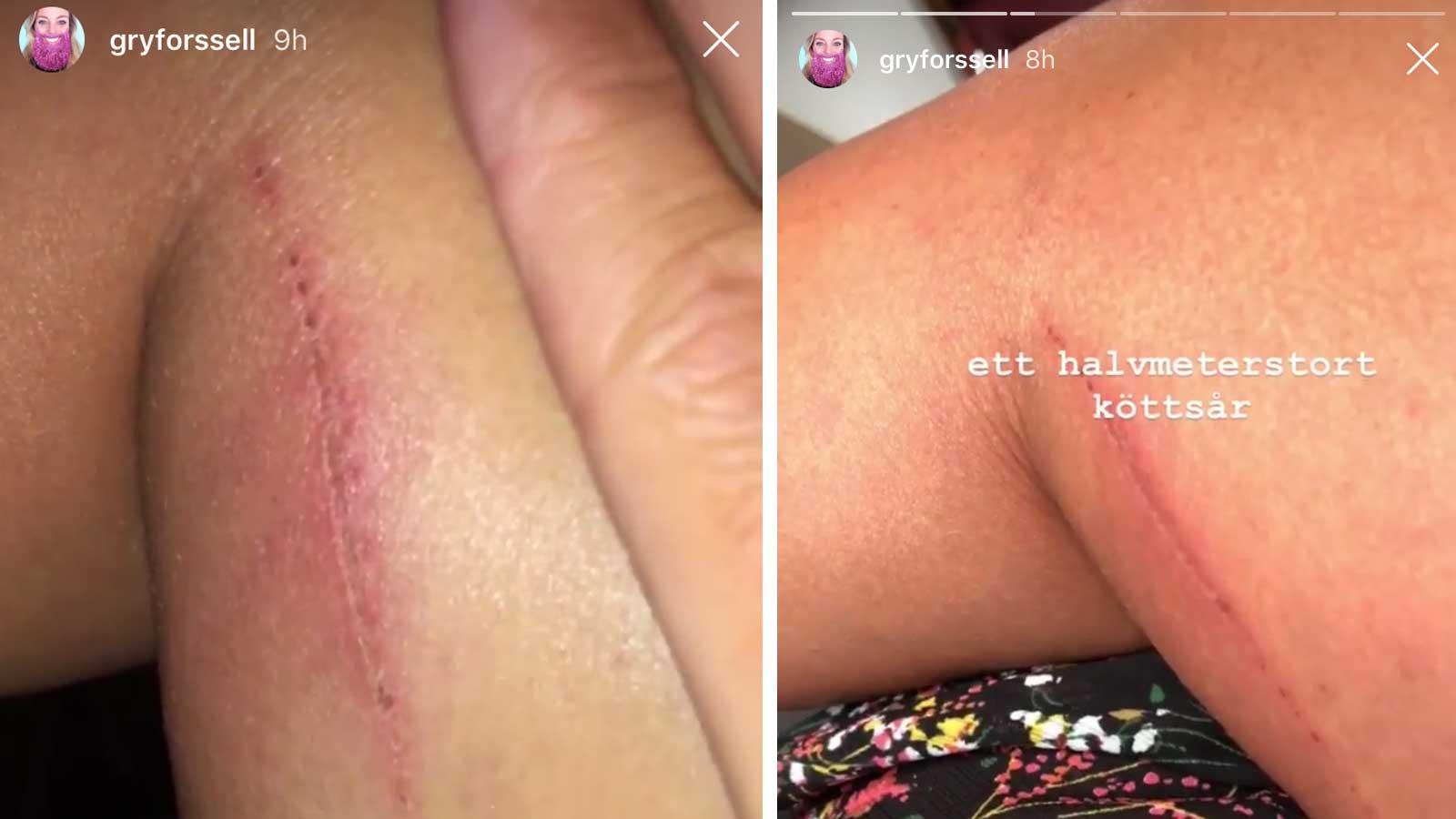 Gry Forssell visar upp skadorna på sitt Instagram.