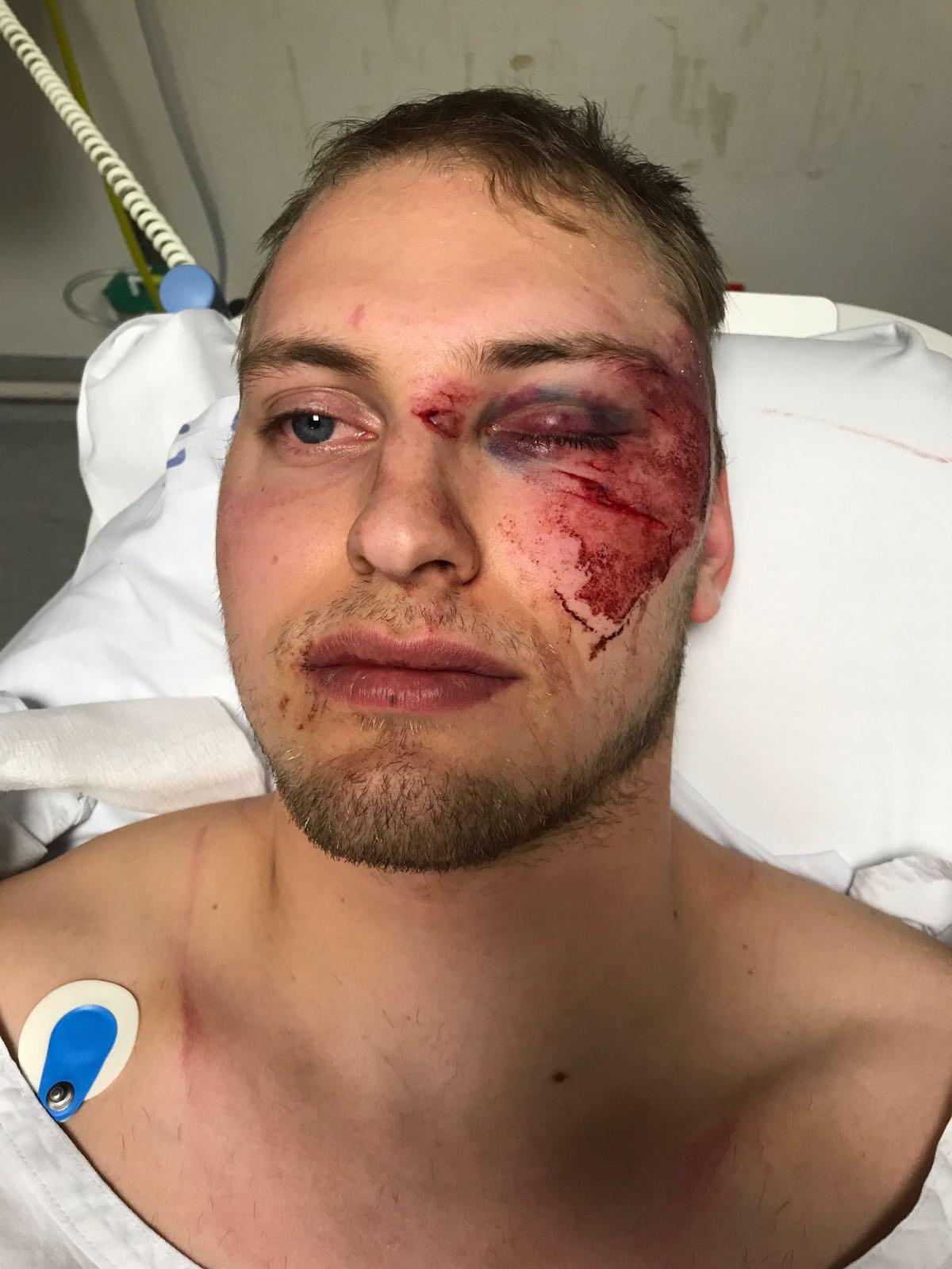 En rejäl blåtira, hjärnskakning och delvis ihopsytt ansikte drabbades Ottosson av efter tacklingen.