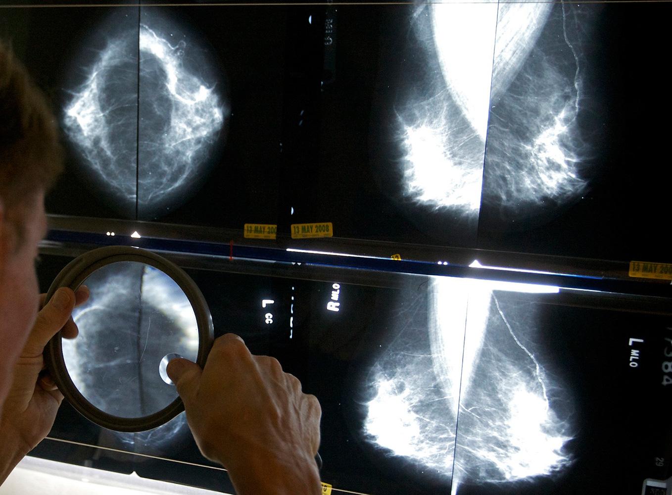 Läkare studerar röntgenbilder på kvinnobröst.