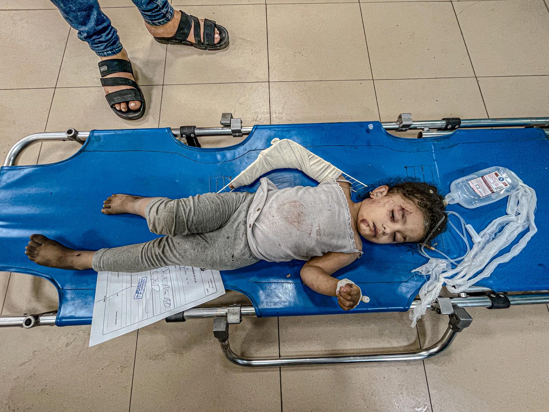 En ung flicka med skadad arm placeras mitt i sjukhuskaoset. Nära hälften av alla de som dör bombattackerna i Gaza beräknas vara barn. 