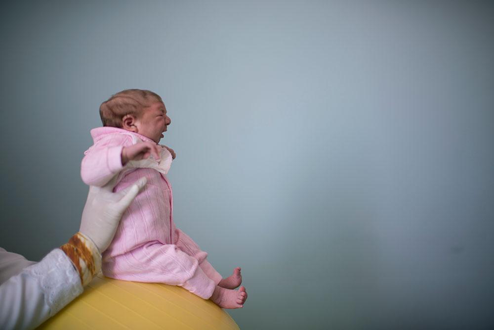 En två veckor gammal flicka från Brasilien med mikrocefali.
