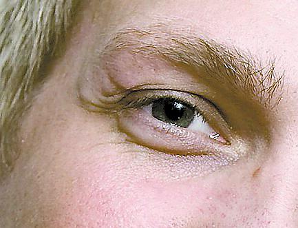 Skadan ovanför ögat har läkt ihop till ett nästan osynligt ärr.