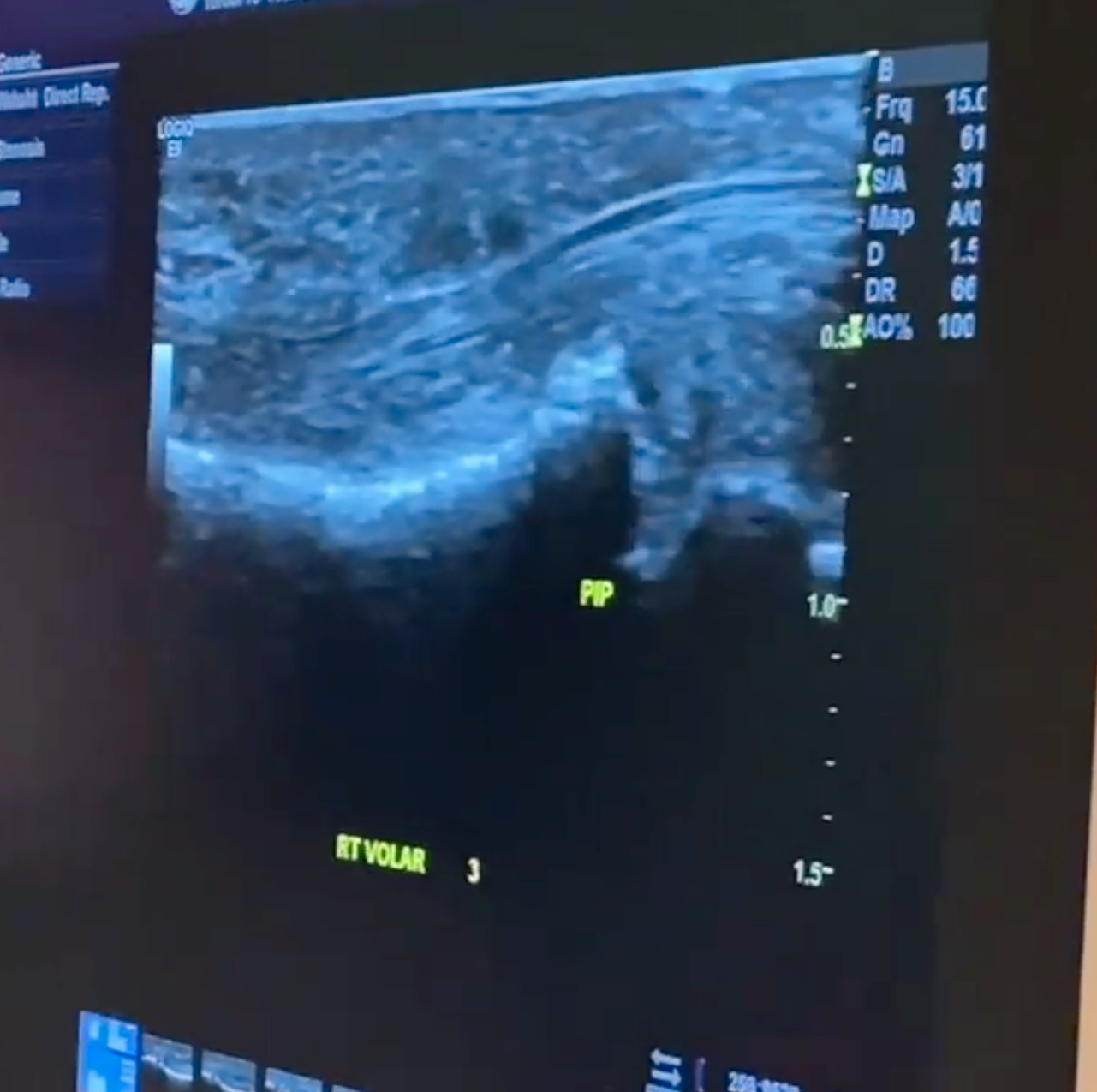 Neil Patrick Harris visar upp ultraljudet som visar den punkterade senan.